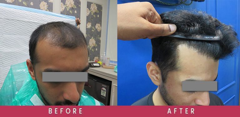 View High-Density Hair Transplant Before and After photos of successful results by Dr. Sumit Agrawal.
