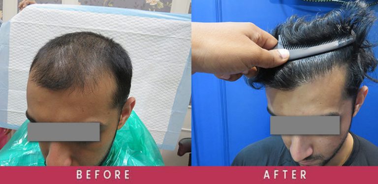 View High-Density Hair Transplant Before and After photos of successful results by Dr. Sumit Agrawal.