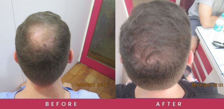  Vertex Hair Transplant Mumbai