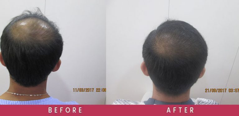 Real Results - Vertex Hair Transplant Real Results - Vertex Hair Transplant