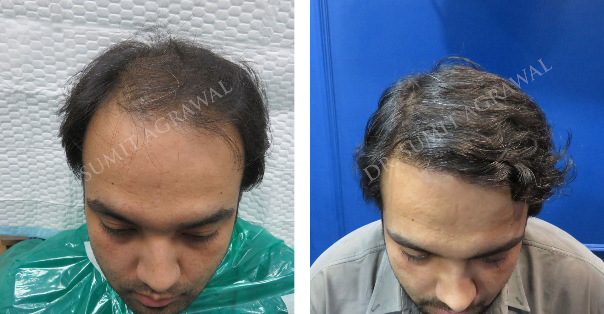 View Fue Hair Transplant Before and After photos of successful results by Dr. Urvashi Chandra.