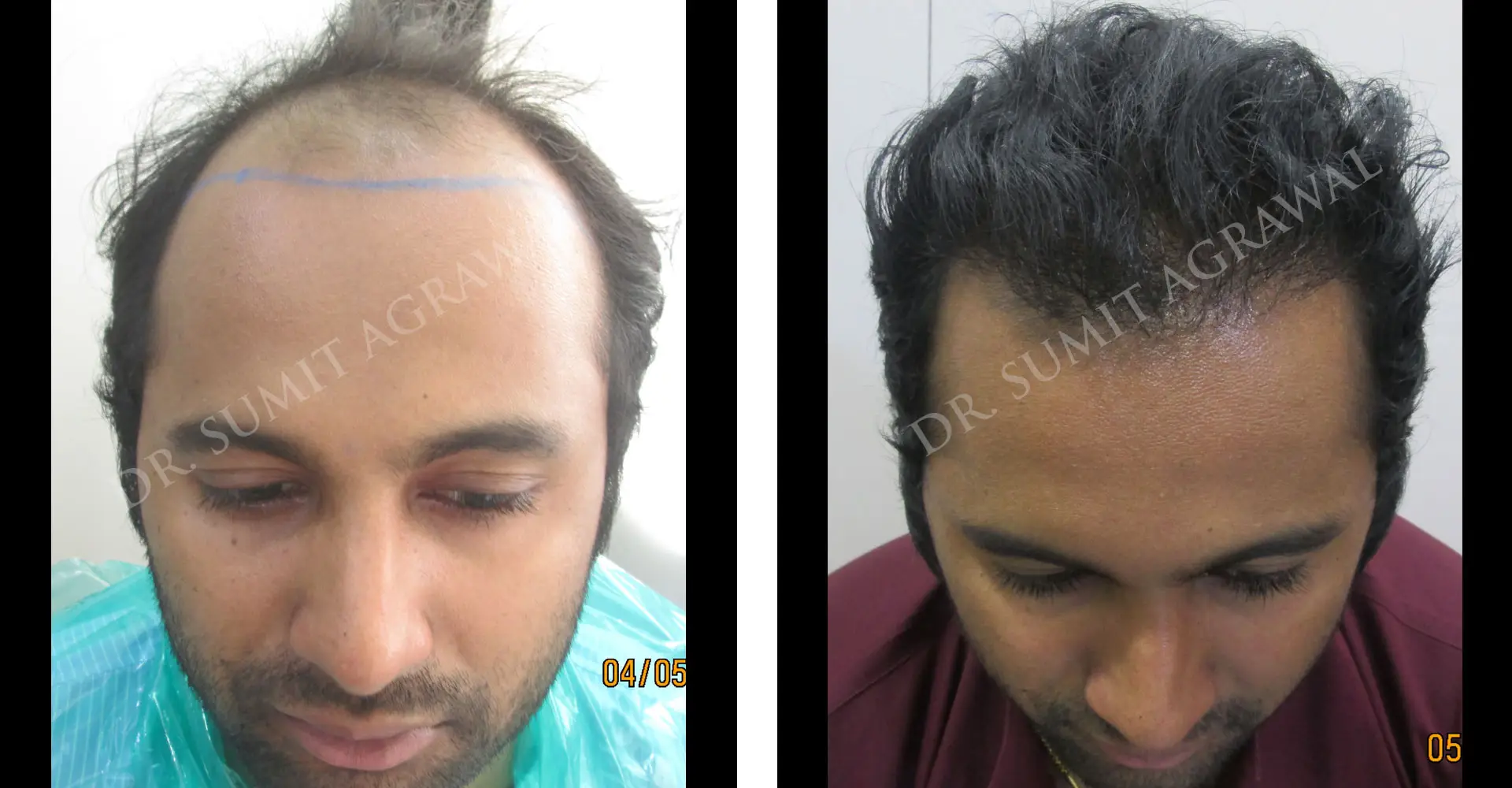 FUT Hair Transplant ! Real Results
