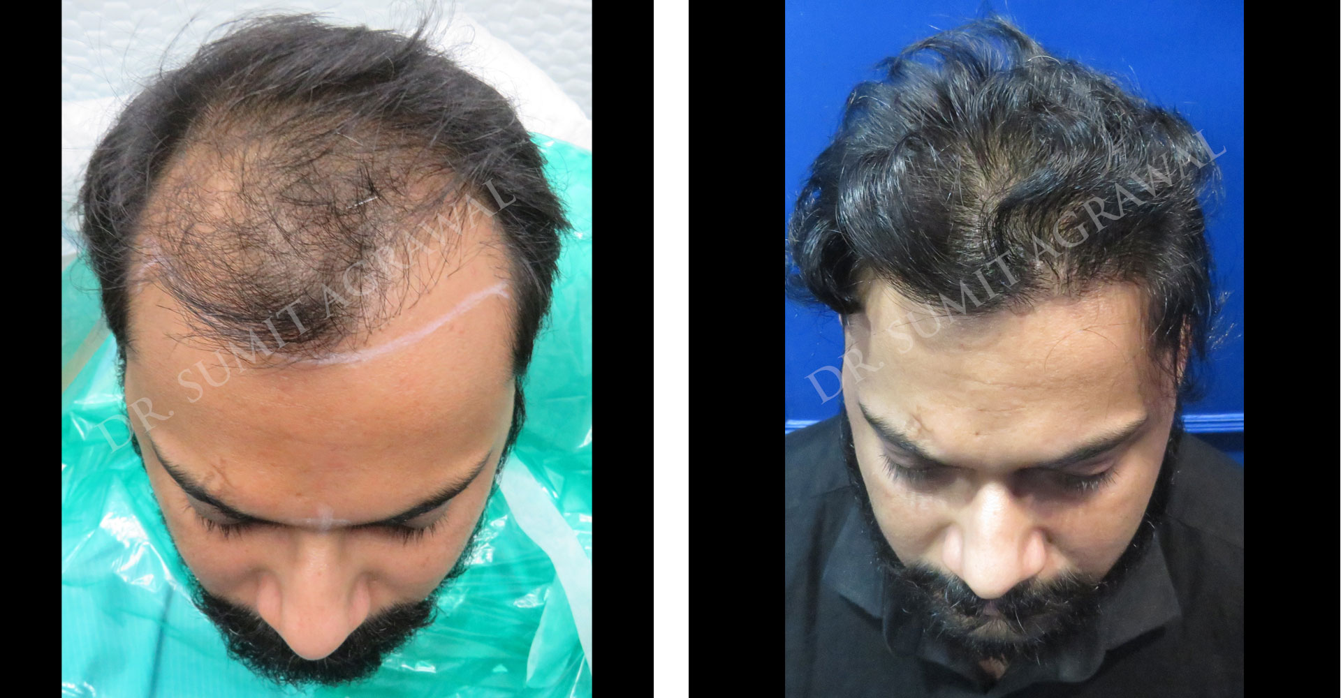 View Revision Hair Transplant Before and After photos of successful results by Dr. Urvashi Chandra.