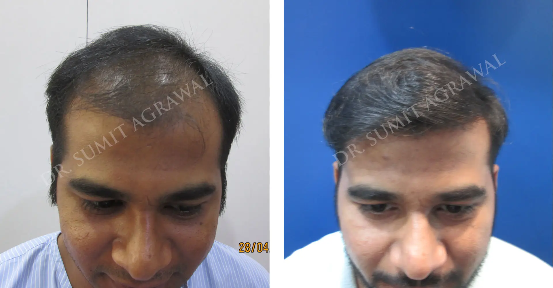 FueHair Transplant Before and After photos of successful results by Dr. Sumit Agrawal. 