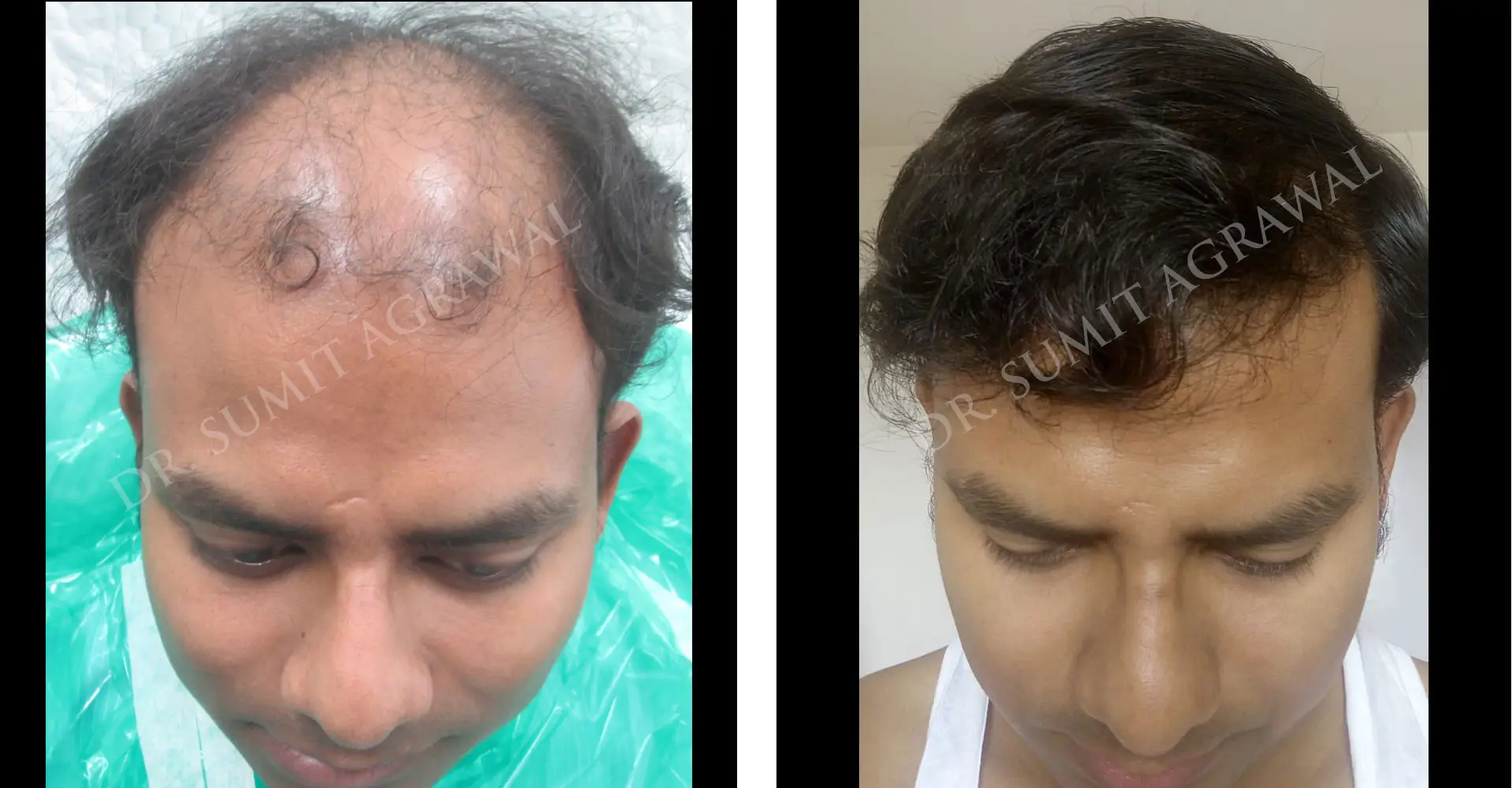 FueHair Transplant Before and After photos of successful results by Dr. Sumit Agrawal. 