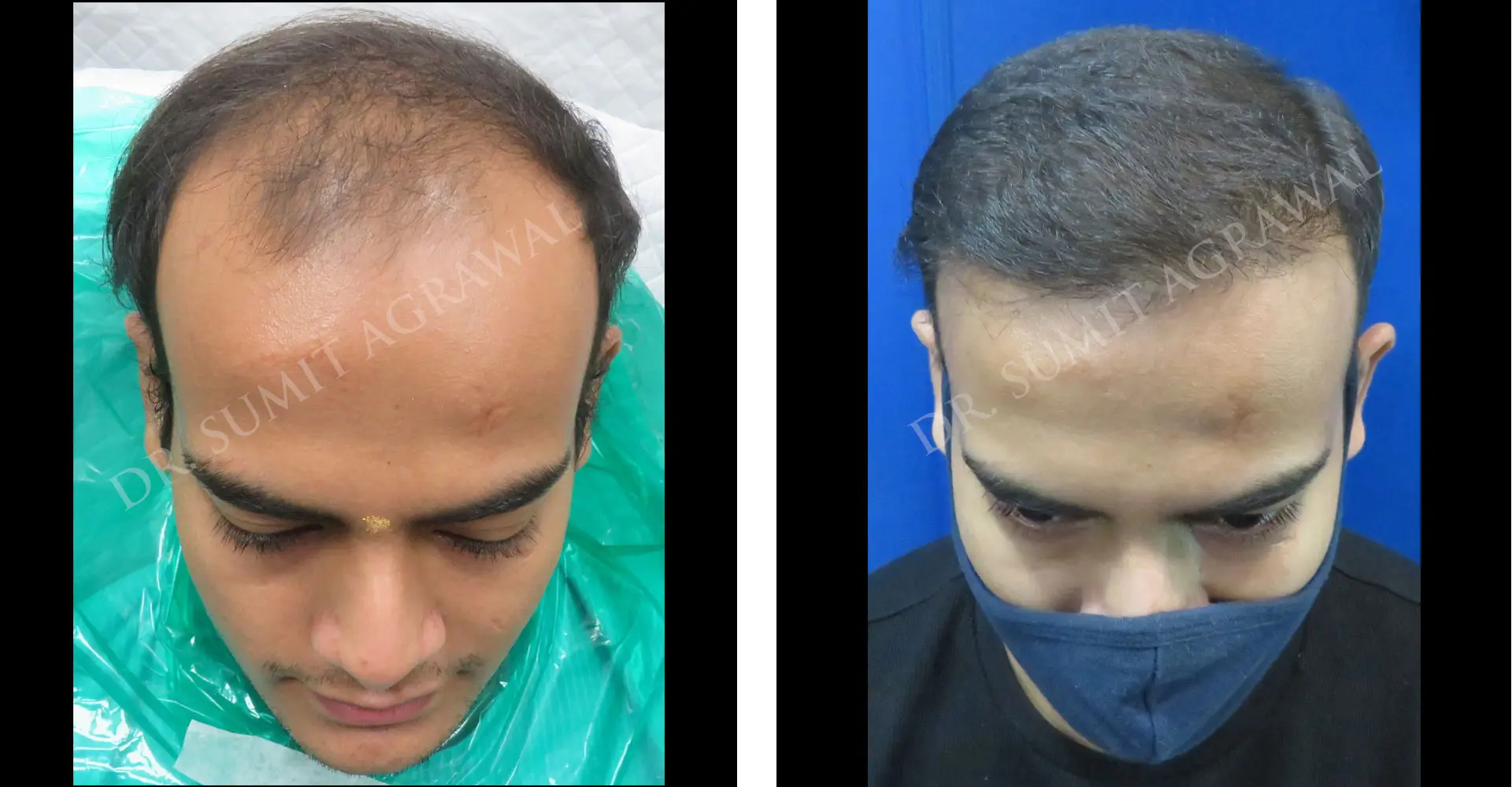 FueHair Transplant Before and After photos of successful results by Dr. Sumit Agrawal. 