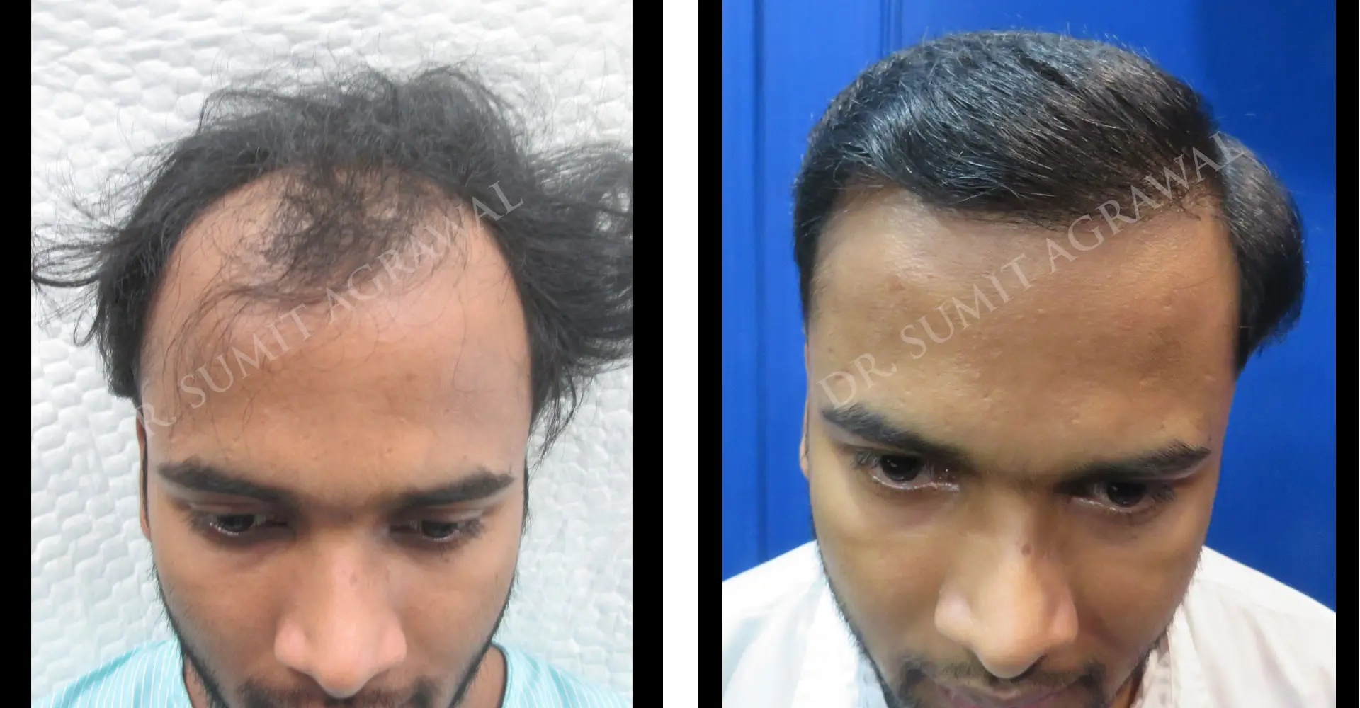 FueHair Transplant Before and After photos of successful results by Dr. Sumit Agrawal. 