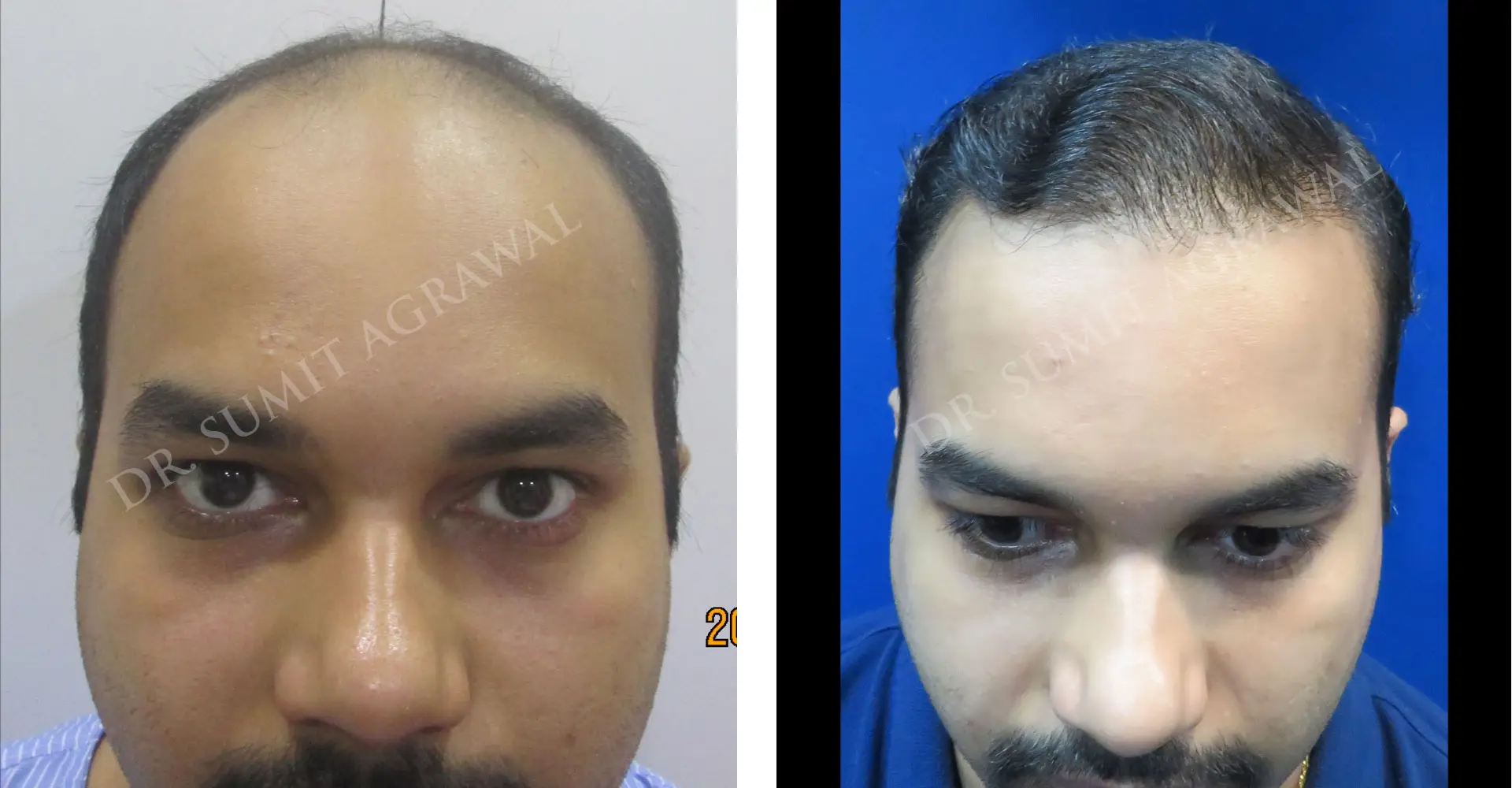 FueHair Transplant Before and After photos of successful results by Dr. Sumit Agrawal. 