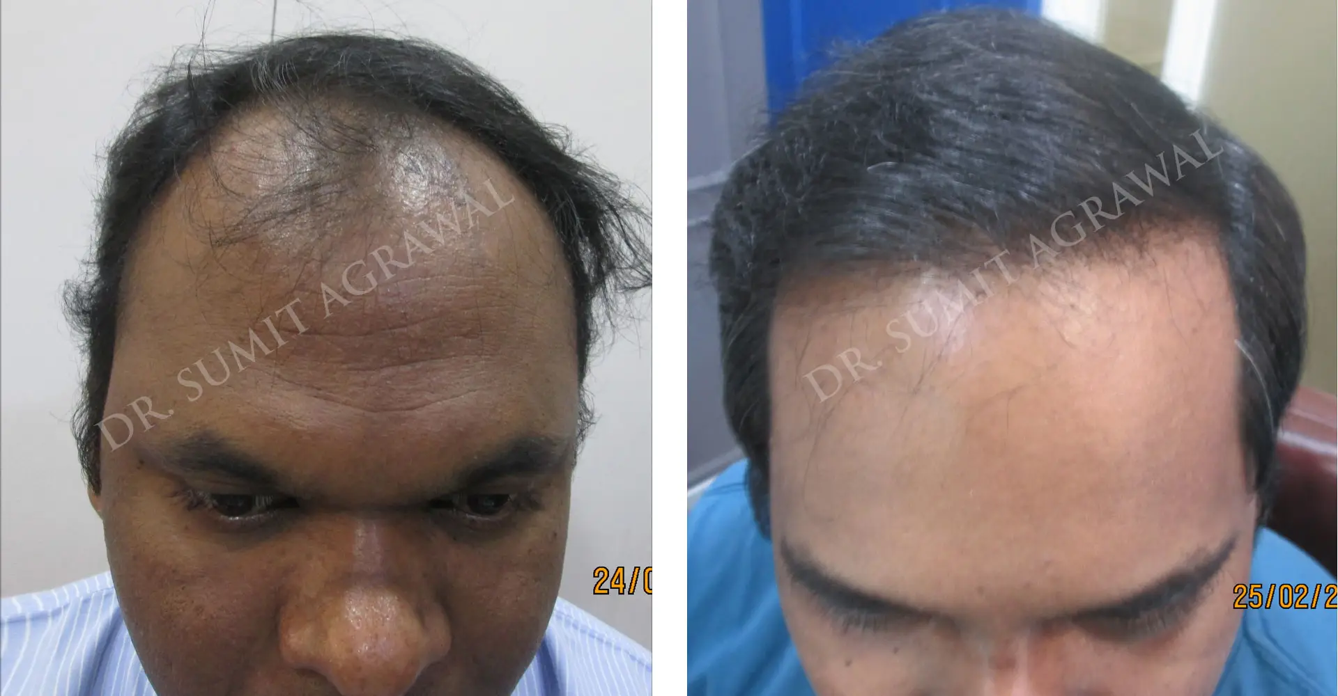 FueHair Transplant Before and After photos of successful results by Dr. Sumit Agrawal. 