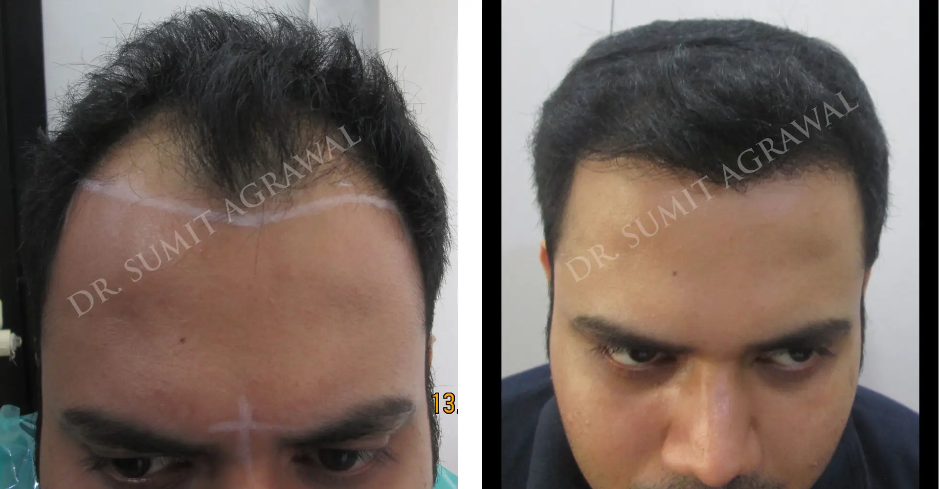 FueHair Transplant Before and After photos of successful results by Dr. Sumit Agrawal. 