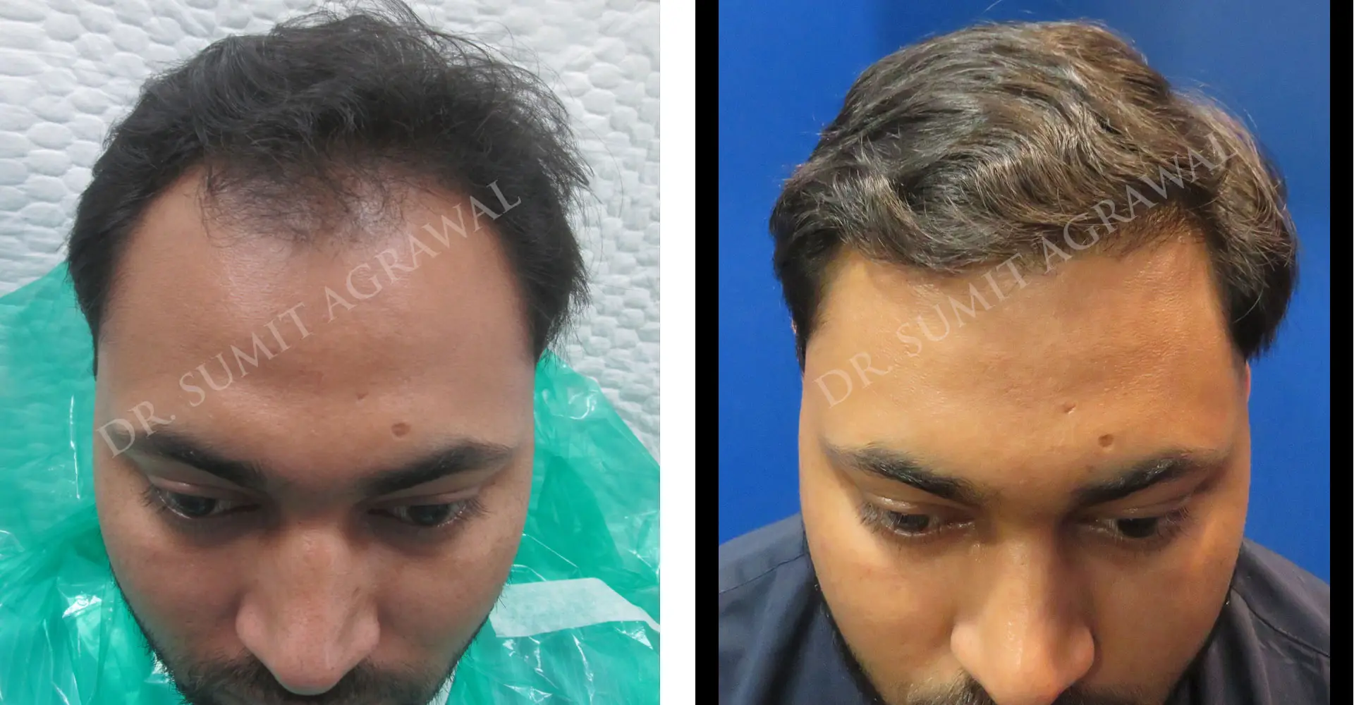 FueHair Transplant Before and After photos of successful results by Dr. Sumit Agrawal. 