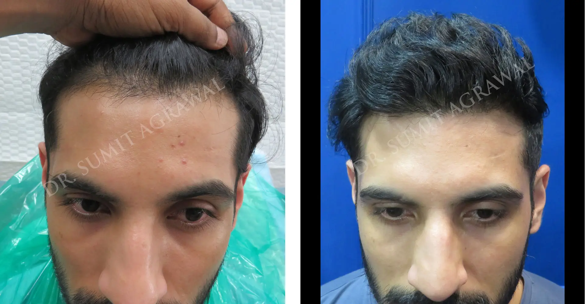 FueHair Transplant Before and After photos of successful results by Dr. Sumit Agrawal. 