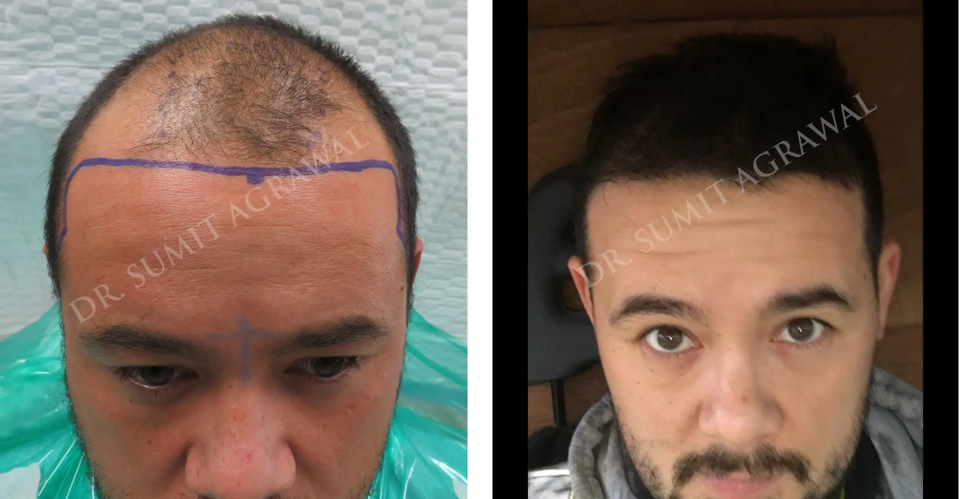 FueHair Transplant Before and After photos of successful results by Dr. Sumit Agrawal. 