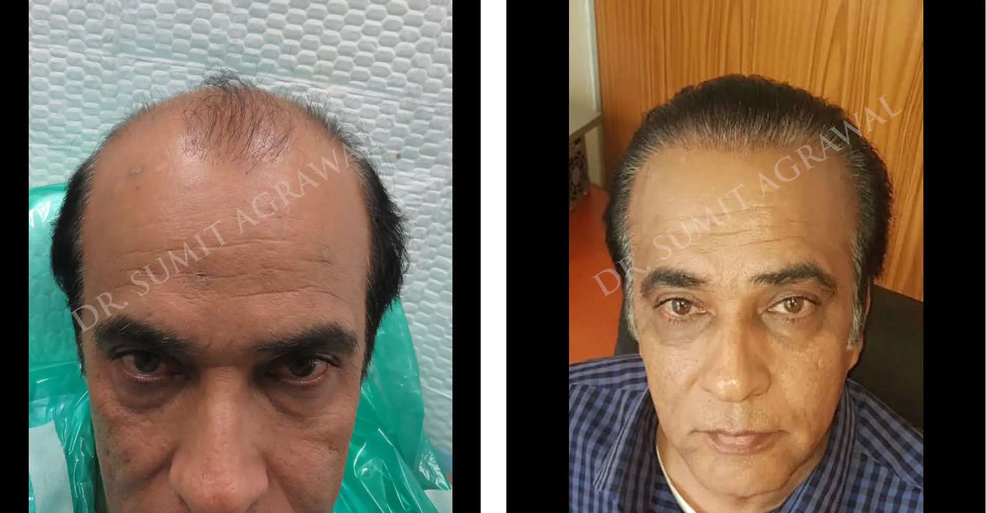 FueHair Transplant Before and After photos of successful results by Dr. Sumit Agrawal. 