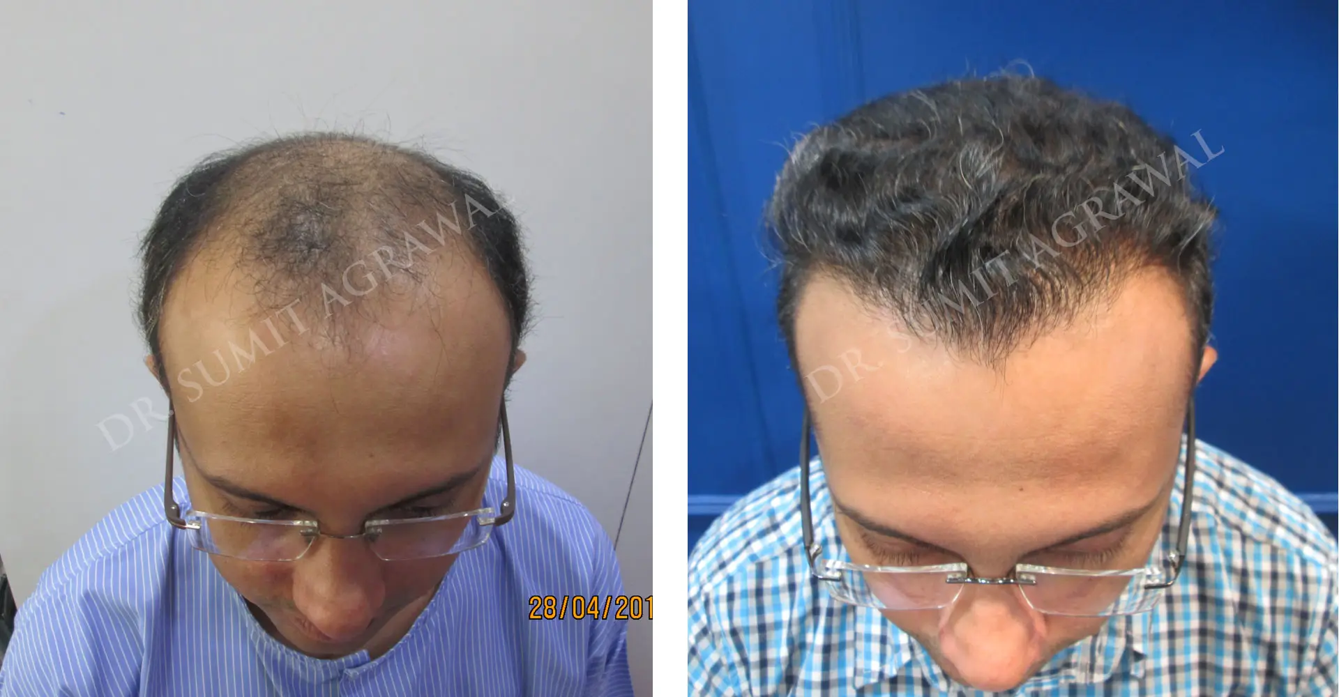 FueHair Transplant Before and After photos of successful results by Dr. Sumit Agrawal. 