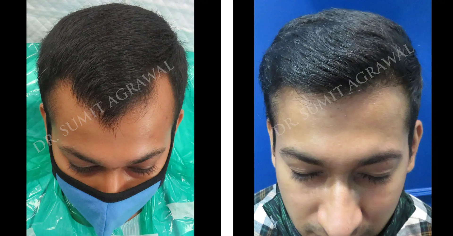 FueHair Transplant Before and After photos of successful results by Dr. Sumit Agrawal. 