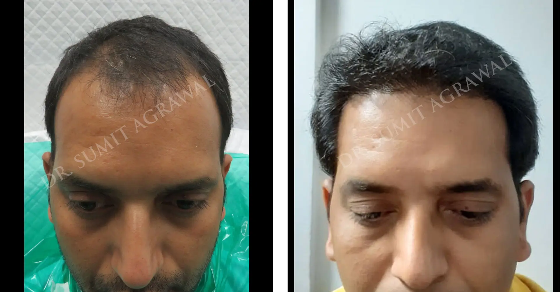 FueHair Transplant Before and After photos of successful results by Dr. Sumit Agrawal. 