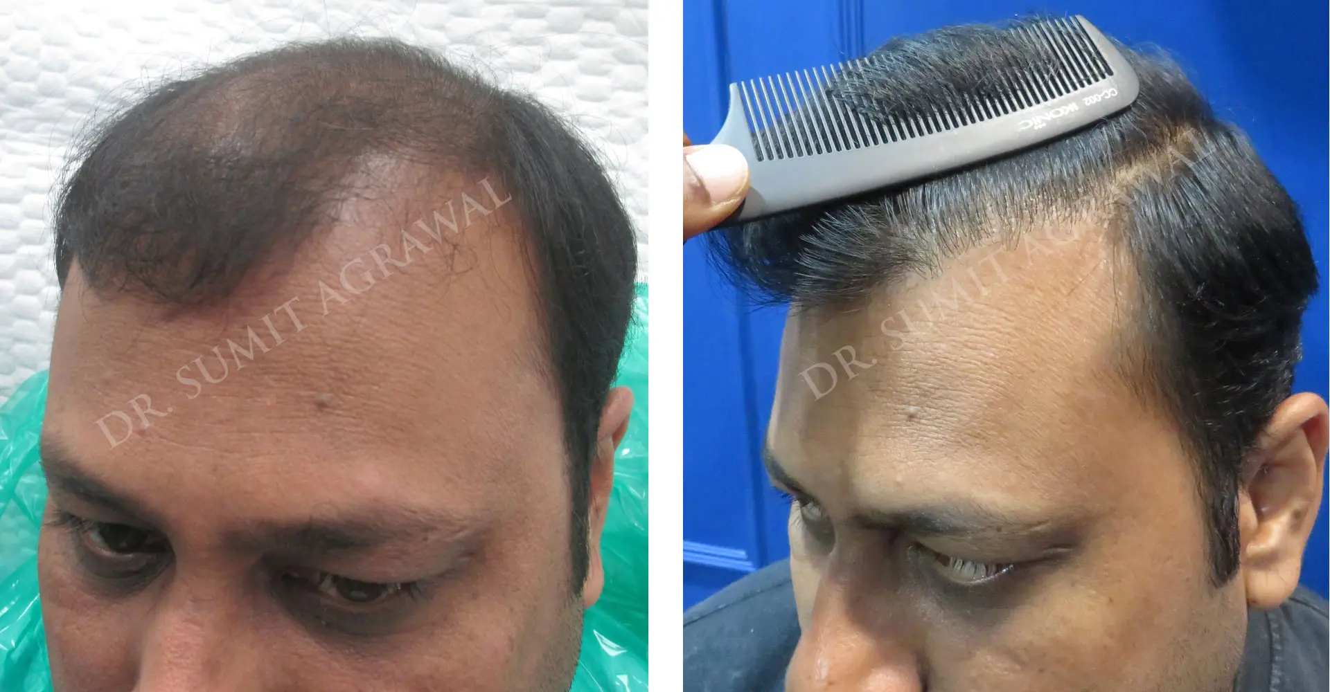 FueHair Transplant Before and After photos of successful results by Dr. Sumit Agrawal. 