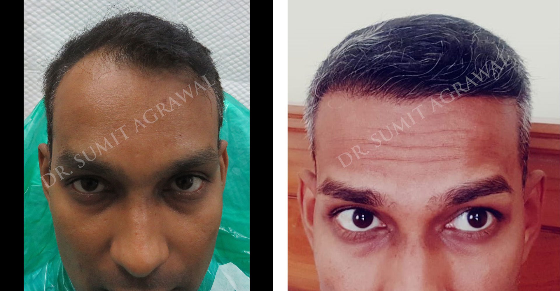 Real Results - FUE Hair Transplant Real Results - FUE Hair Transplant