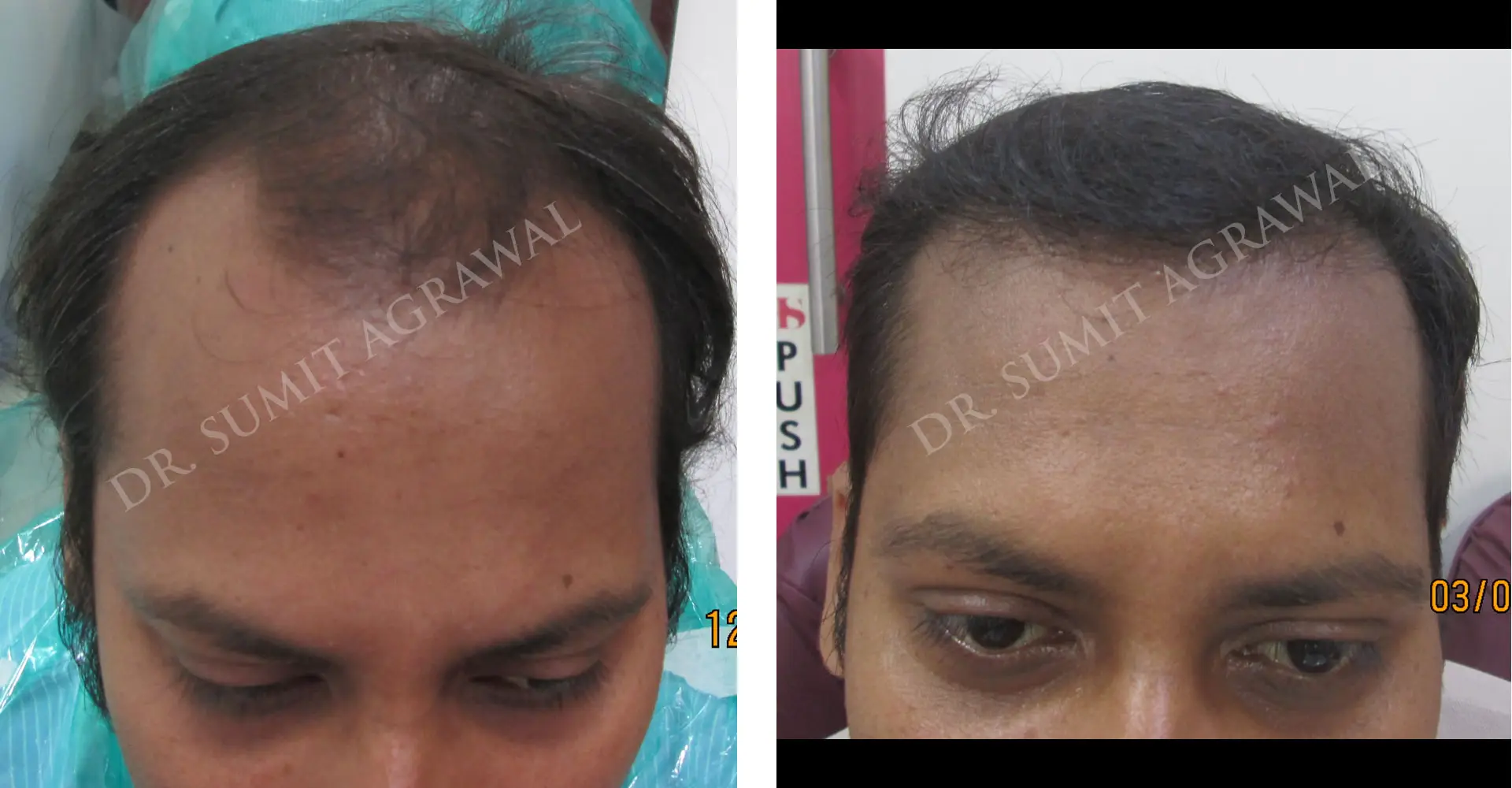 FueHair Transplant Before and After photos of successful results by Dr. Sumit Agrawal. 