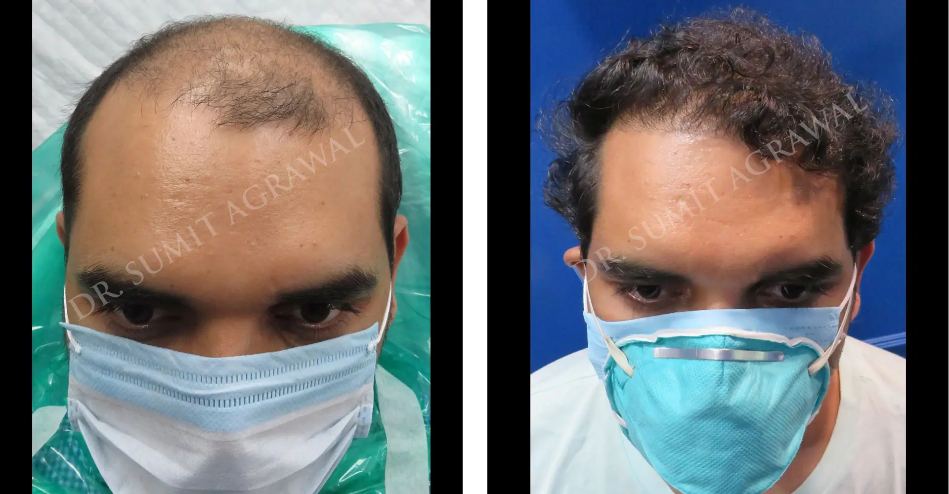 FueHair Transplant Before and After photos of successful results by Dr. Sumit Agrawal. 