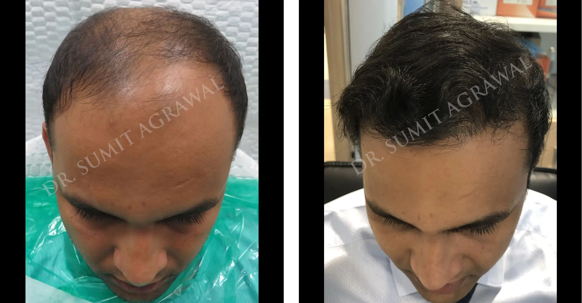 FueHair Transplant Before and After photos of successful results by Dr. Sumit Agrawal. 
