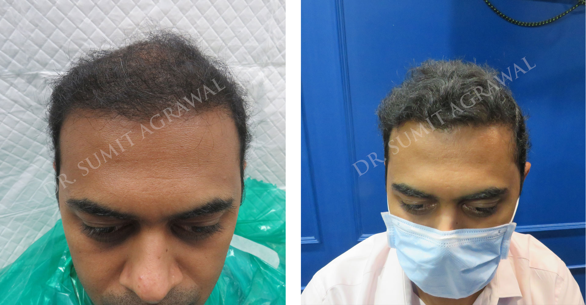 Naturallooking hair transplant of curly hair  best hair transplant clinic  in Mumbai  YouTube