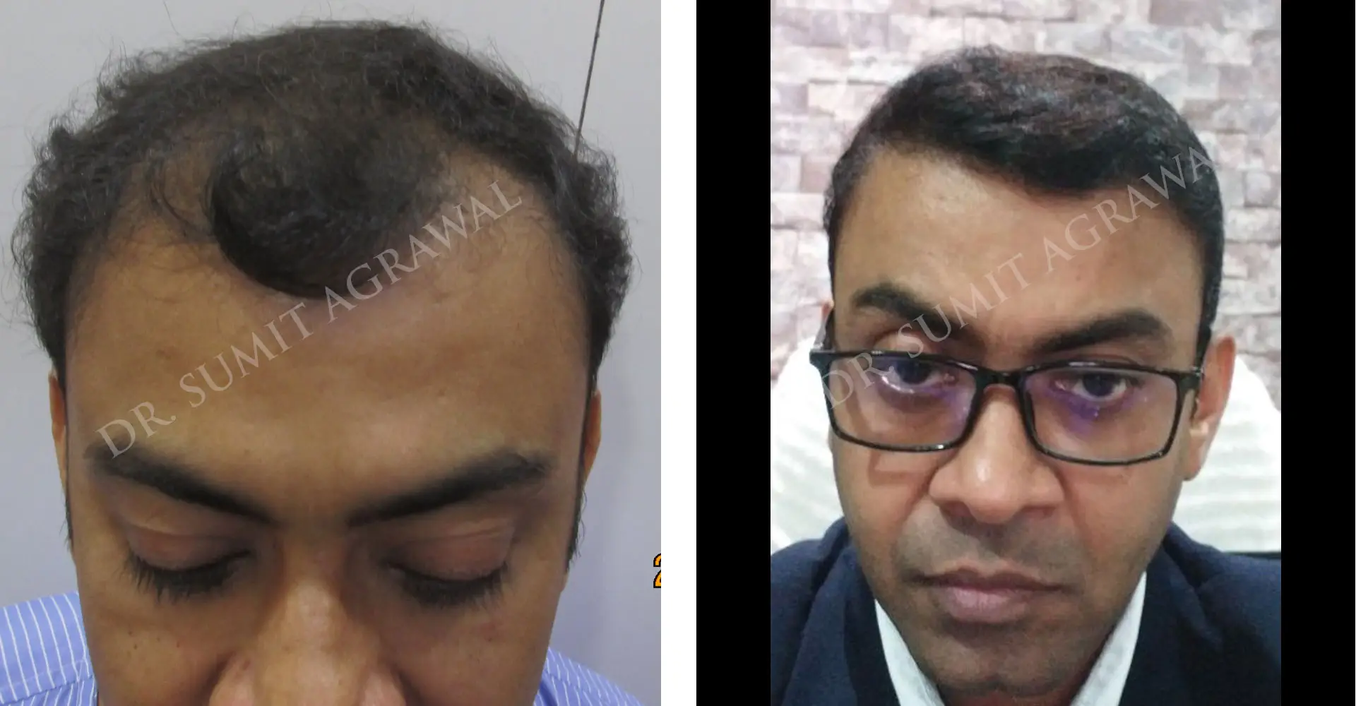 Revision Results Before and After 
