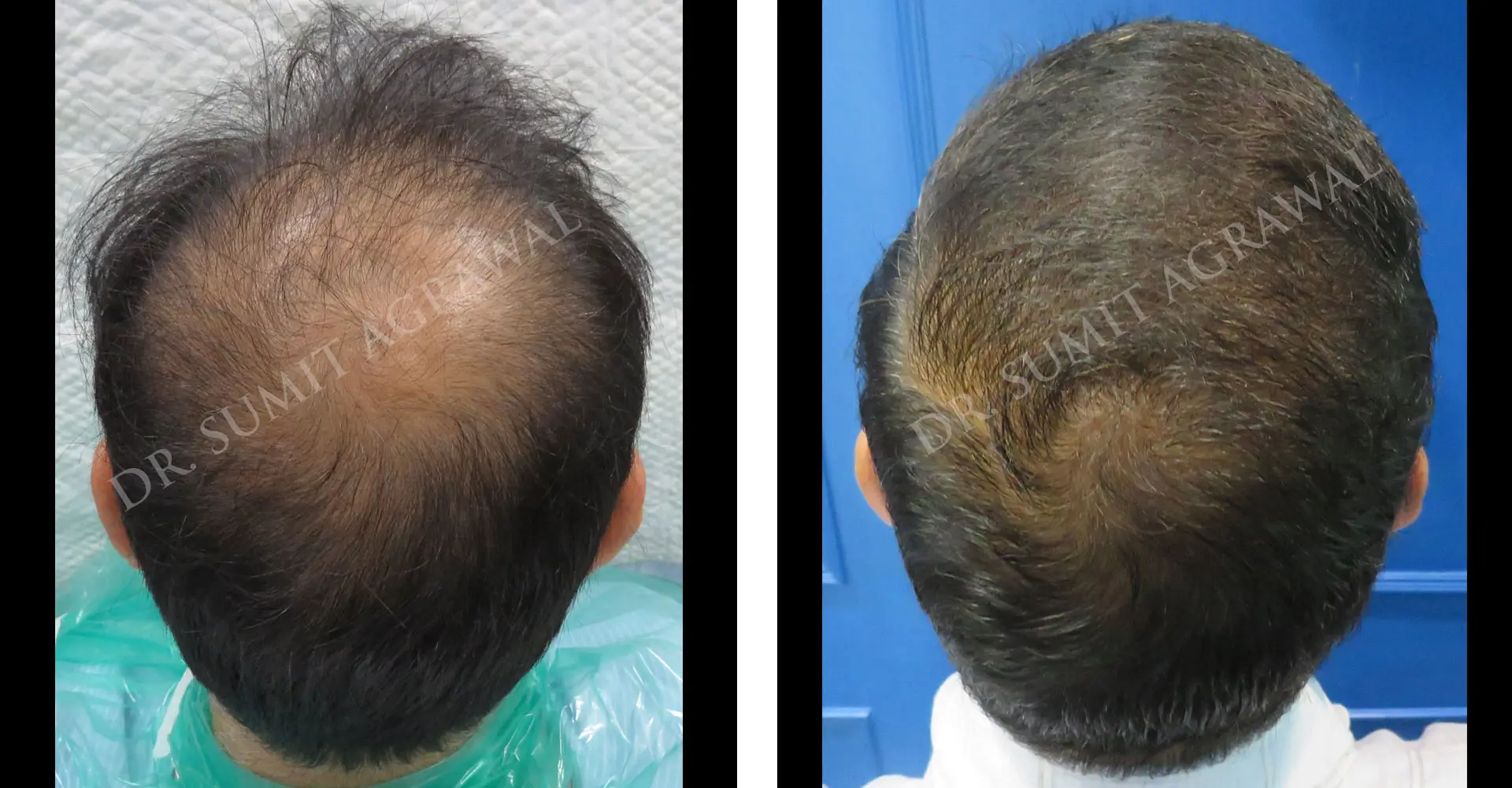 A.K. Vertex Results 