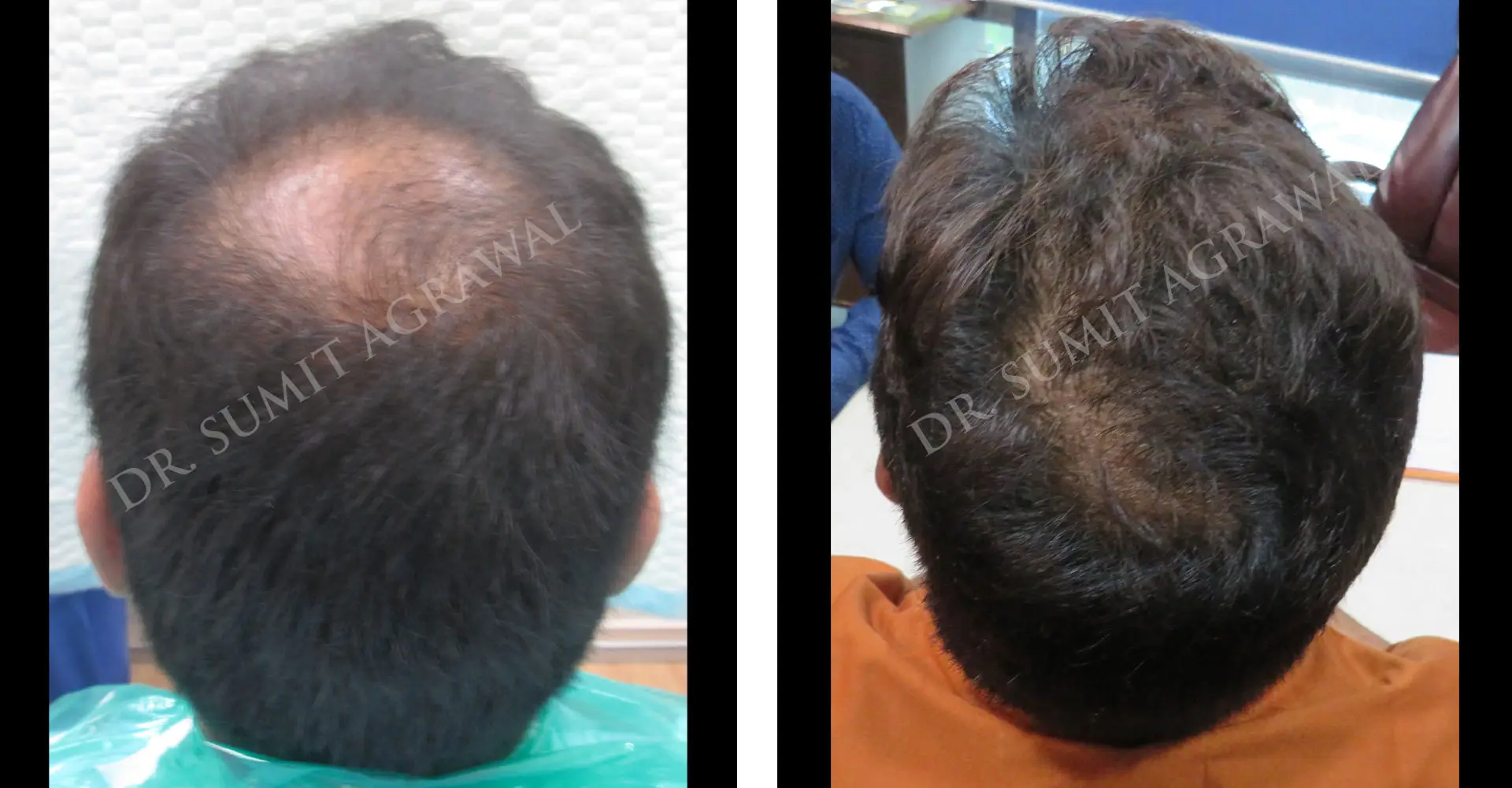 Vertex Hair Transplant Results Before and After 