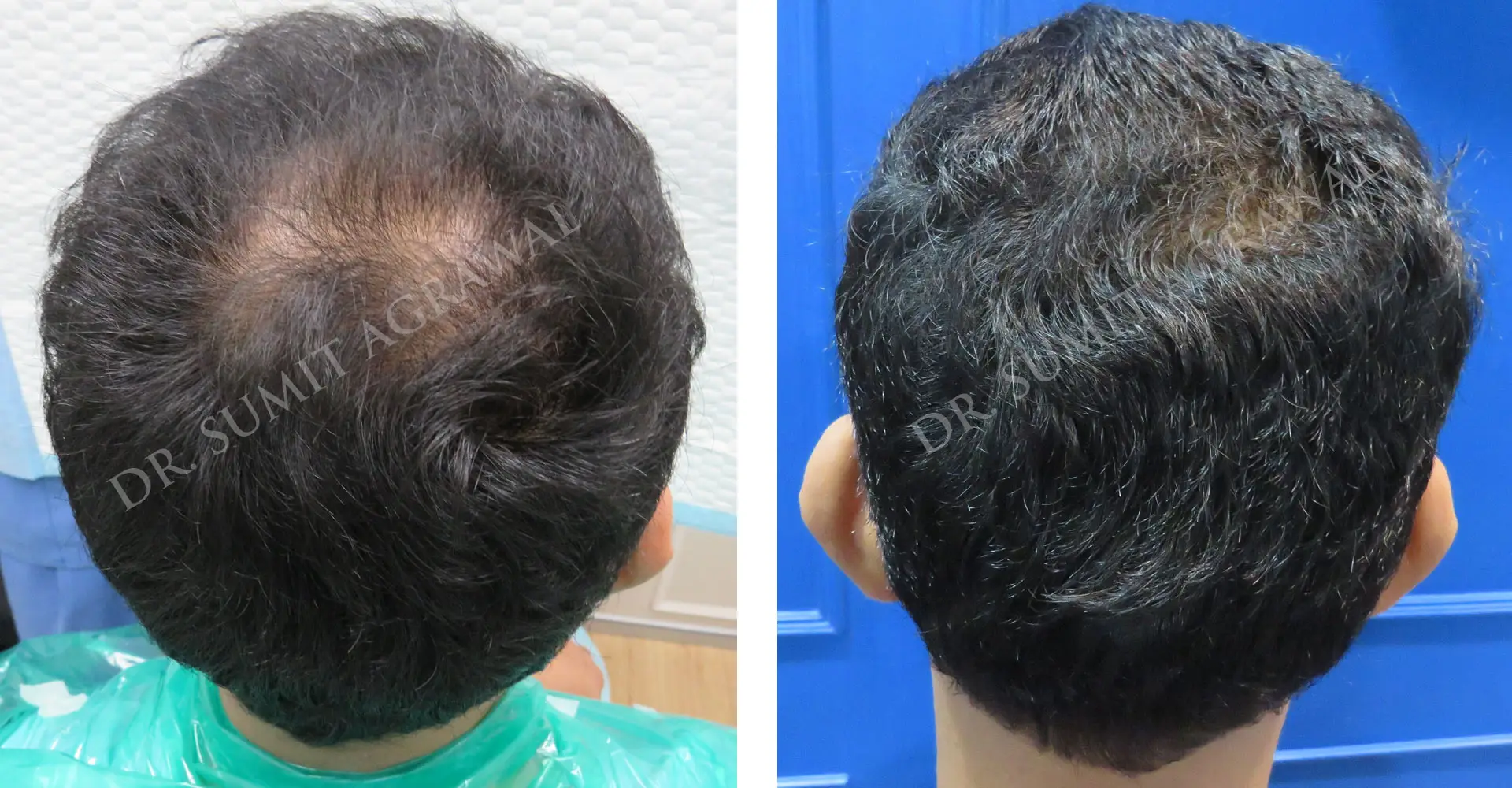 Vertex Hair Transplant Results Before and After 