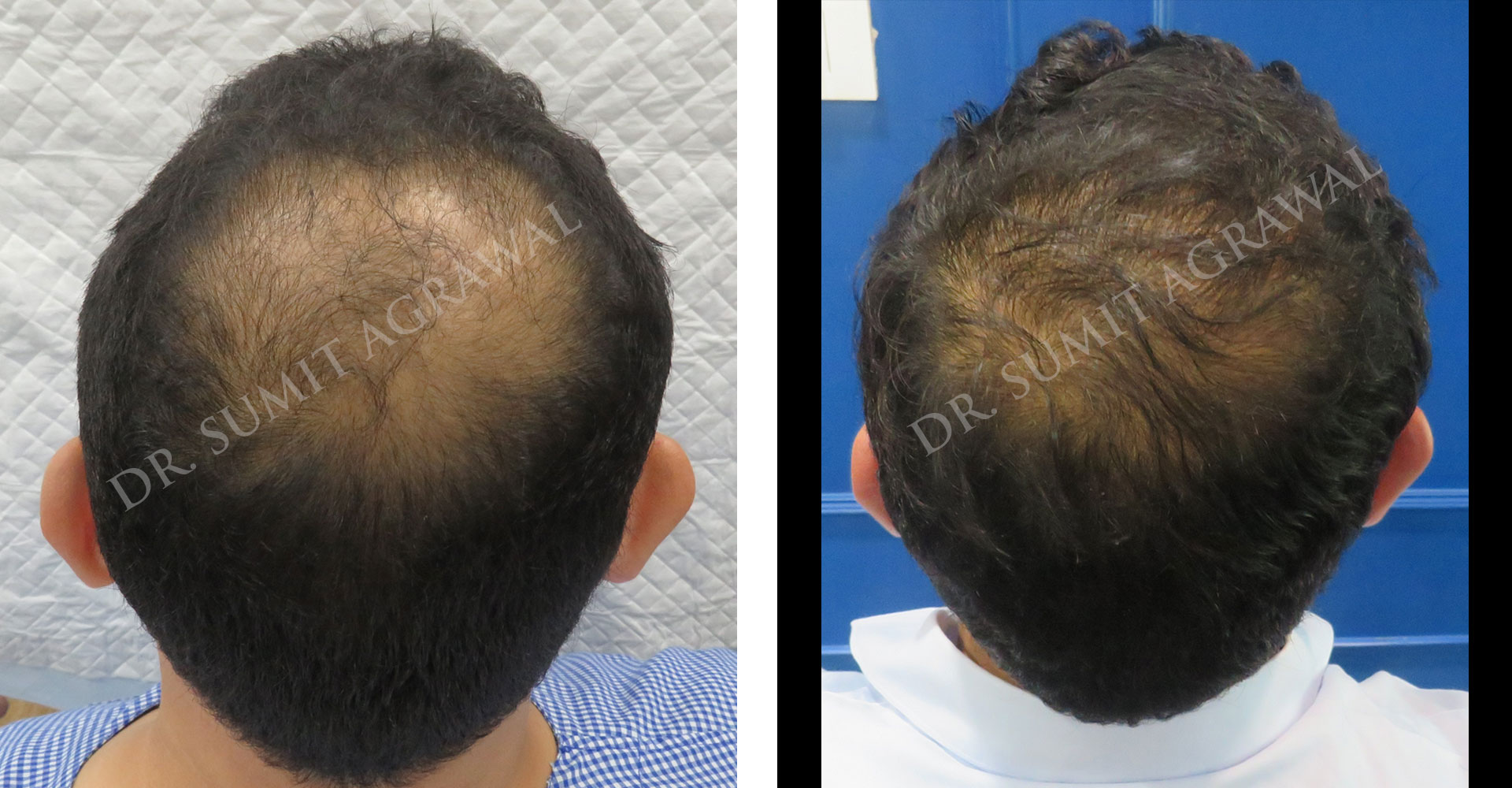 View Vertex (crown) Hair Transplant Before and After photos of successful results by Dr. Urvashi Chandra.