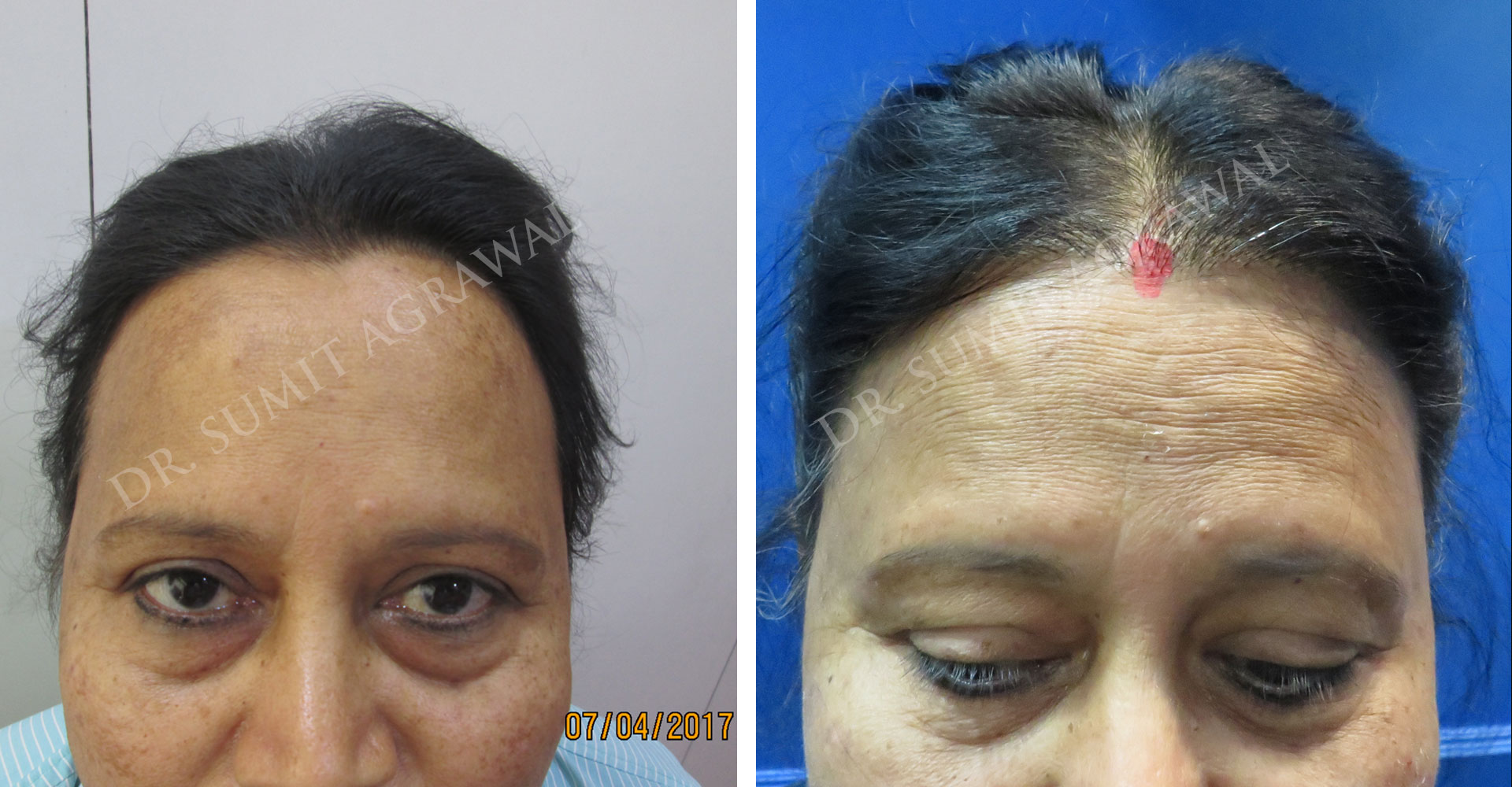 Female Hair Transplant Before and After photos of successful results by Dr. Urvashi Chandra.