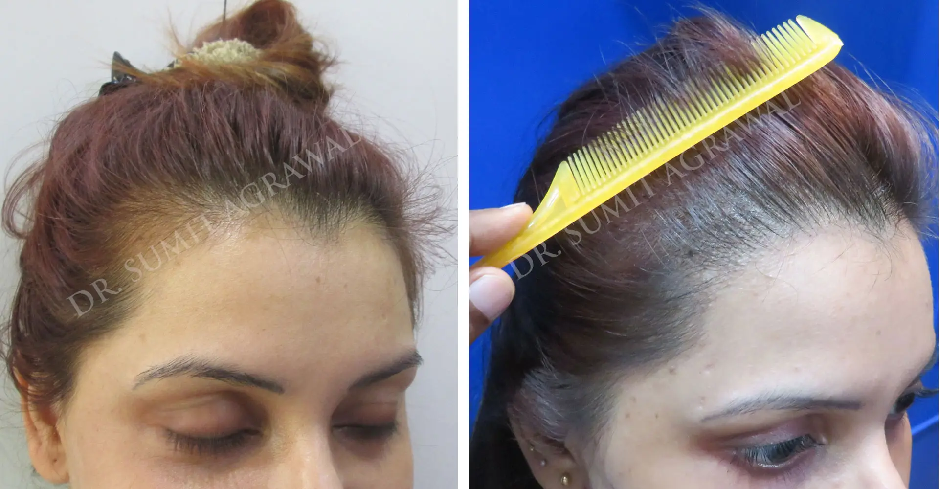 Hair Transplant 