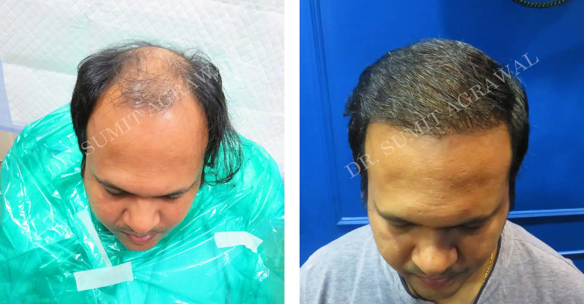 FueHair Transplant Before and After photos of successful results by Dr. Sumit Agrawal. 