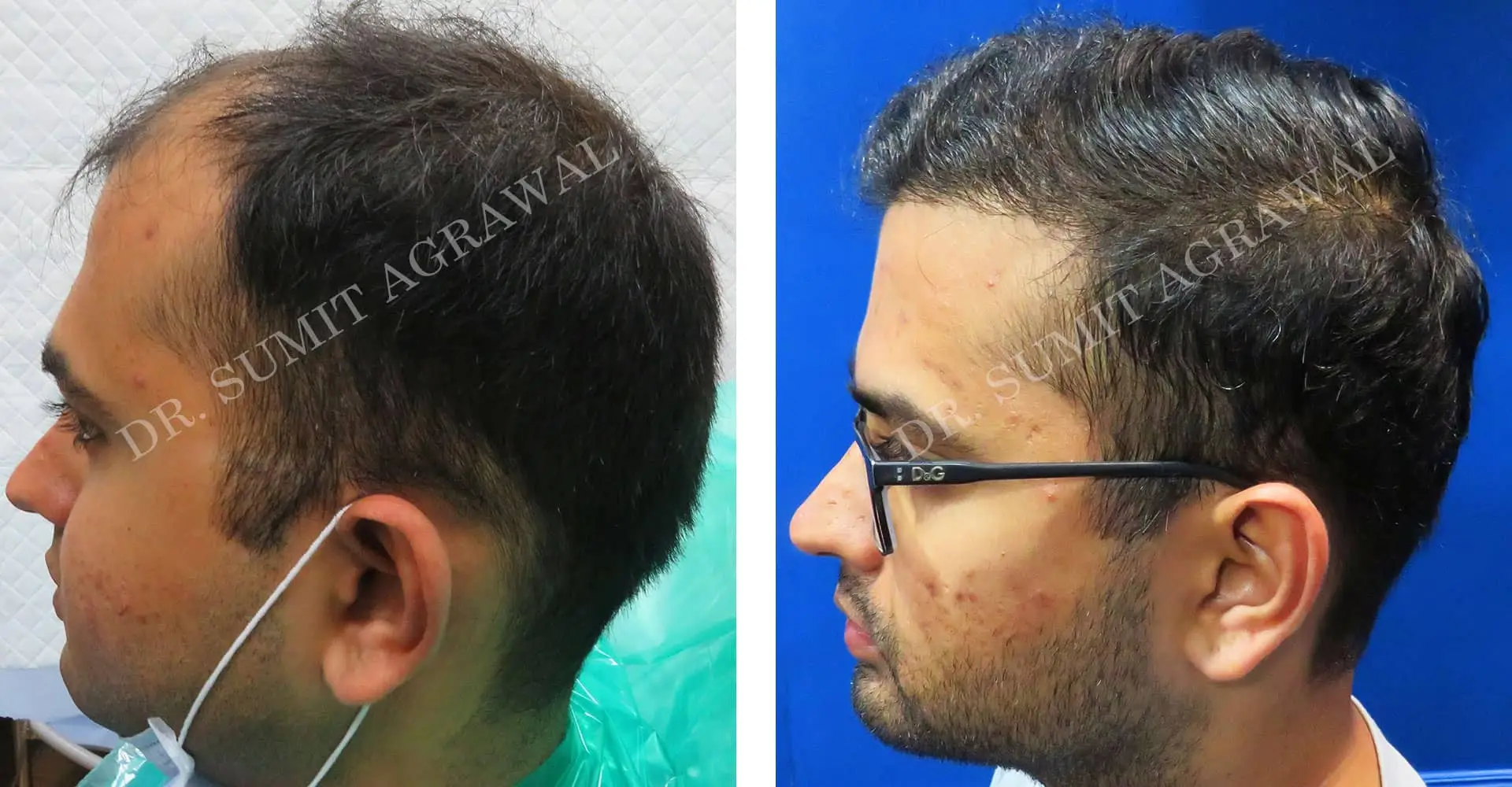 FueHair Transplant Before and After photos of successful results by Dr. Sumit Agrawal. 
