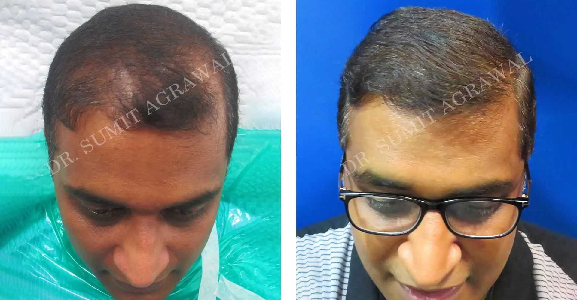 FueHair Transplant Before and After photos of successful results by Dr. Sumit Agrawal. 