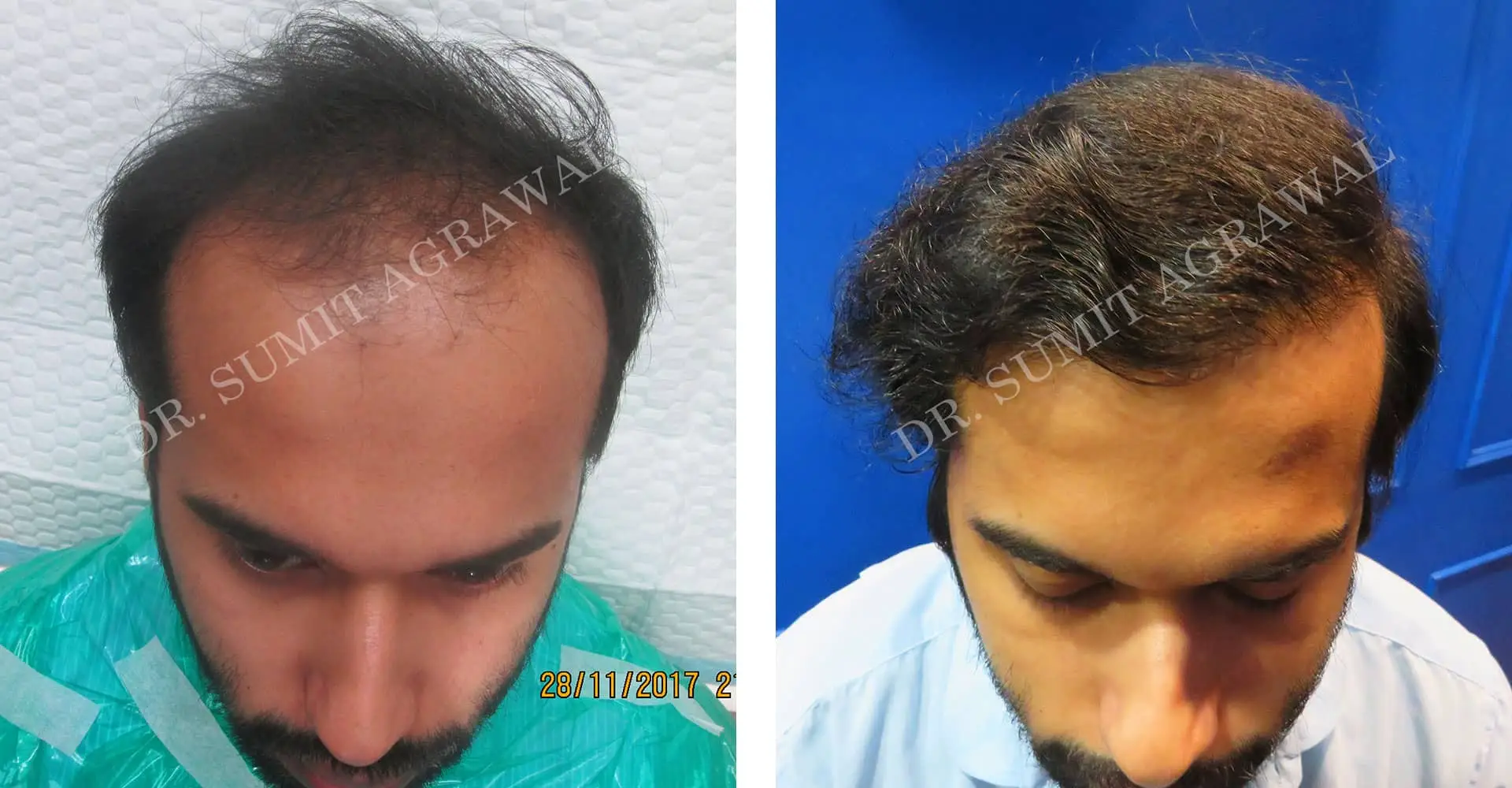 FueHair Transplant Before and After photos of successful results by Dr. Sumit Agrawal. 