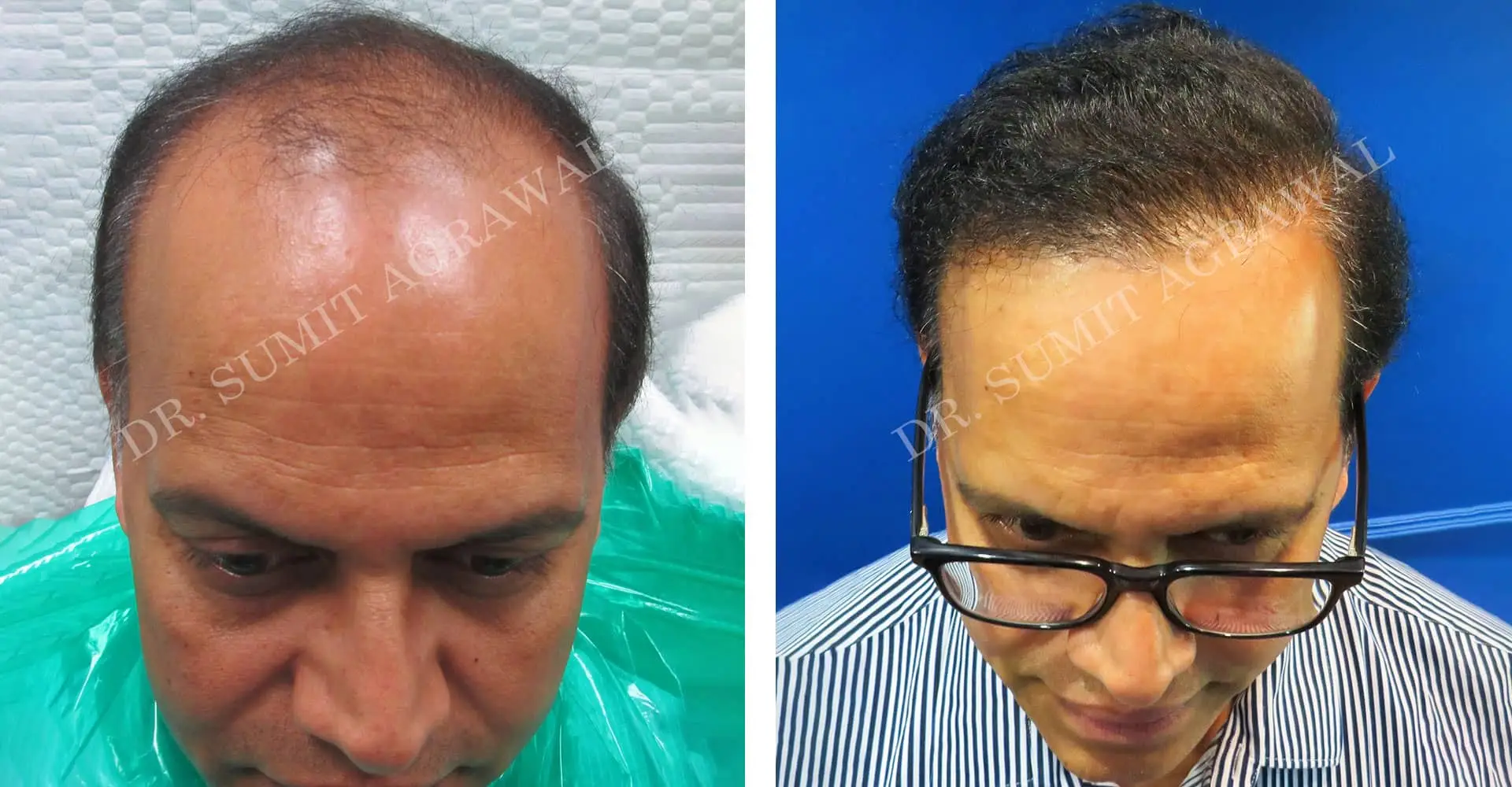 FueHair Transplant Before and After photos of successful results by Dr. Sumit Agrawal. 