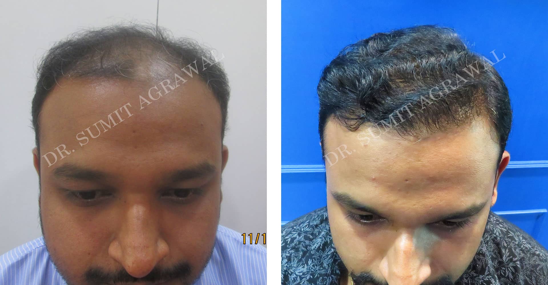 Hair Loss Treatment: Hair Transplant or Microneedling with PRP?