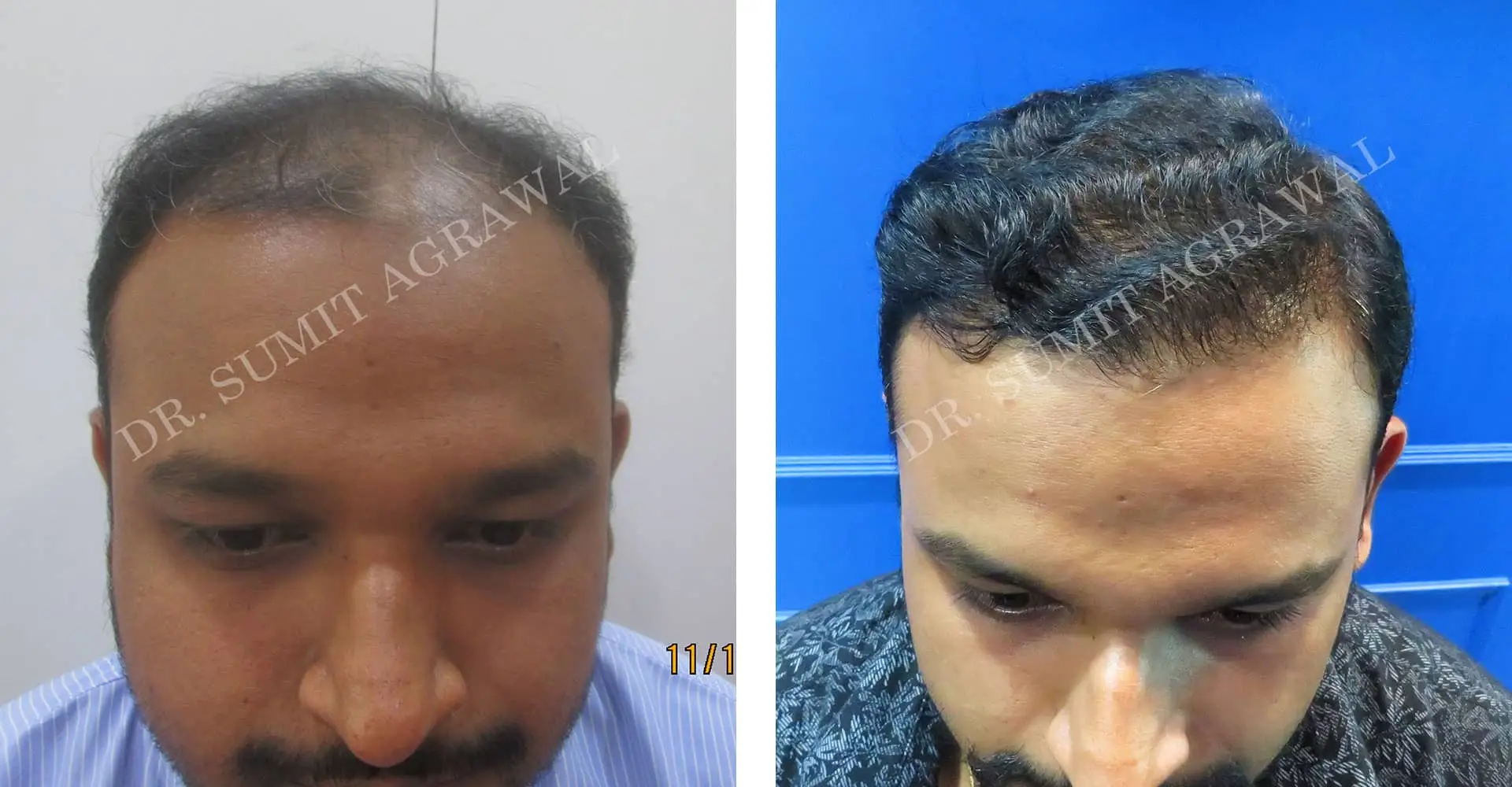 FueHair Transplant Before and After photos of successful results by Dr. Sumit Agrawal. 