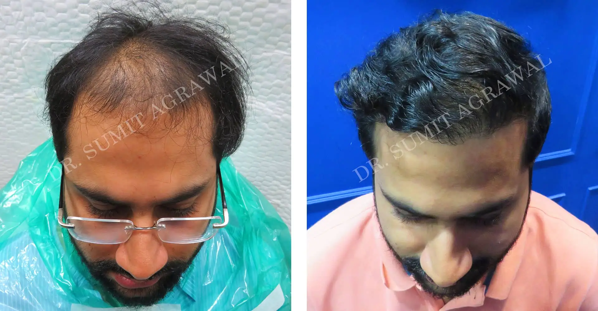 FueHair Transplant Before and After photos of successful results by Dr. Sumit Agrawal. 