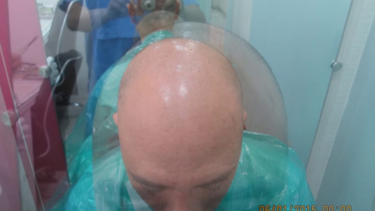 BioFUE Hair Transplant journey of 1 year - Harleys Hair Transplant clinic in Mumbai 