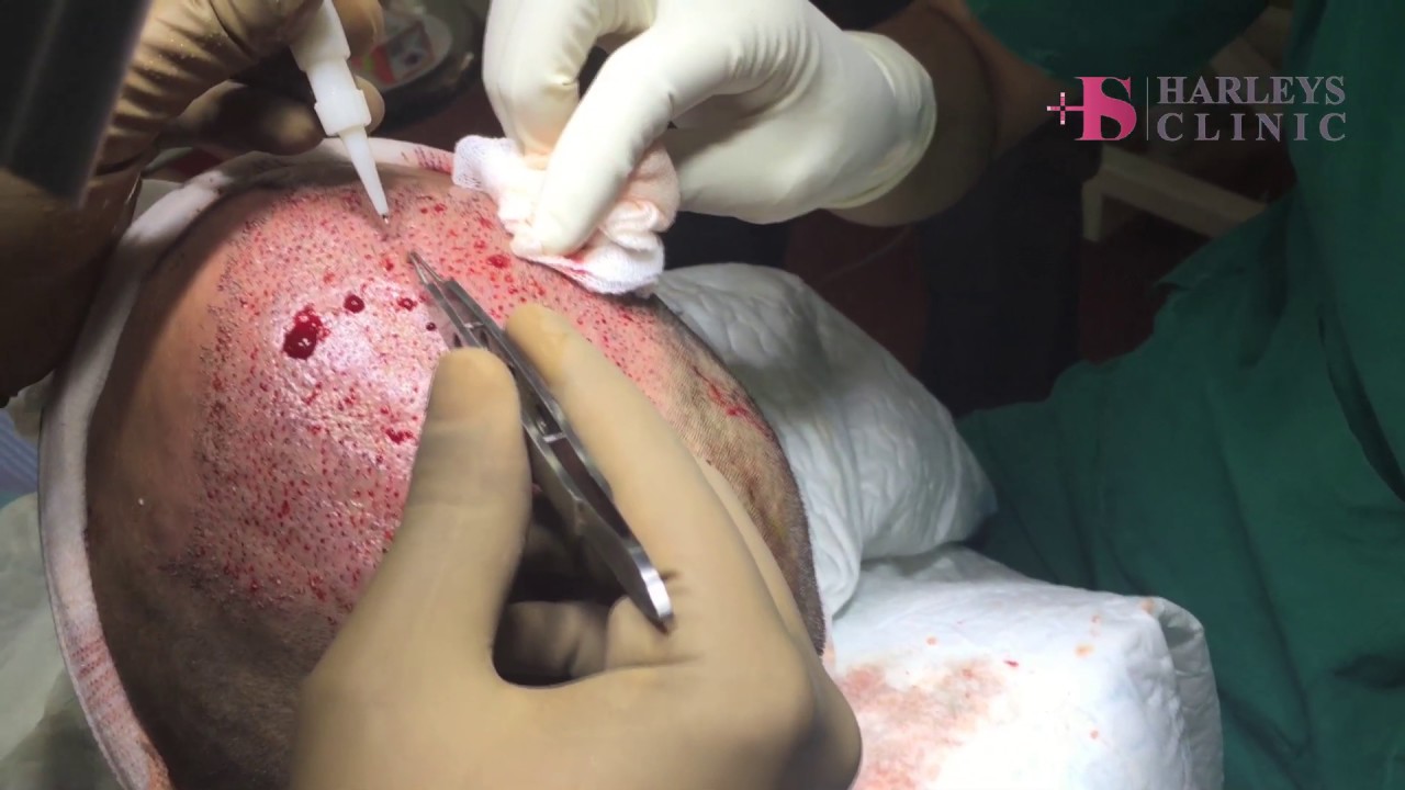 Hair Transplant Procedure at Harleys Hair Transplant Clinic in Mumbai 