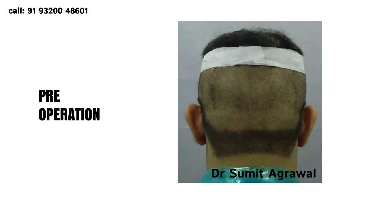 FUE Hair Transplant in Mumbai - Harleys Clinic 