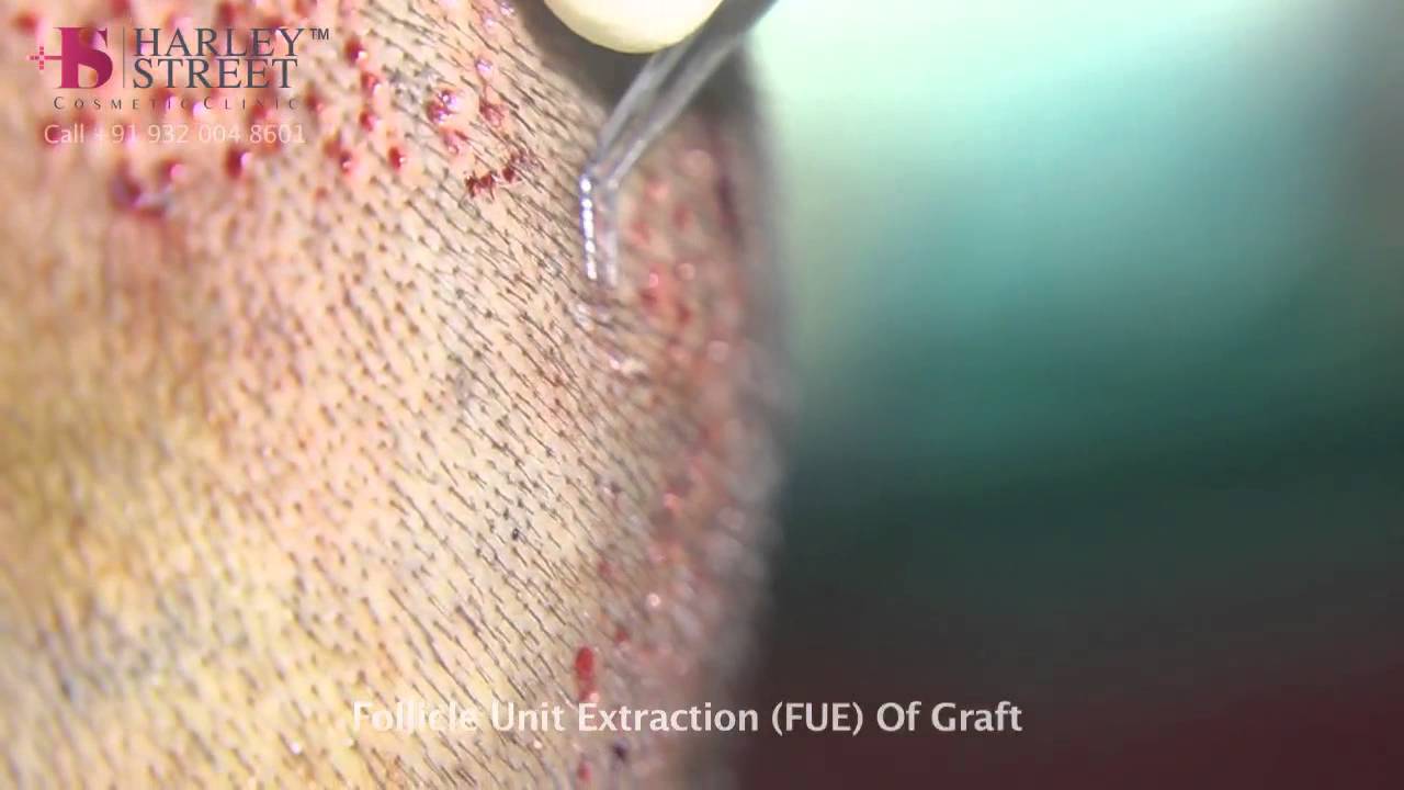  FUE Hair Transplant technique of Hair Transplant by Dr Sumit Agrawal