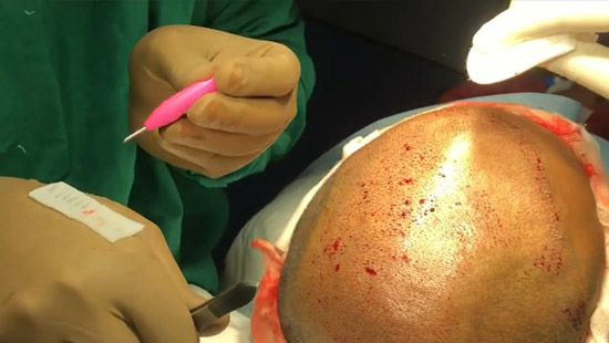 Live Hair Transplant Surgery 