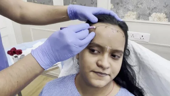  Female Hair Transplant in Mumbai
