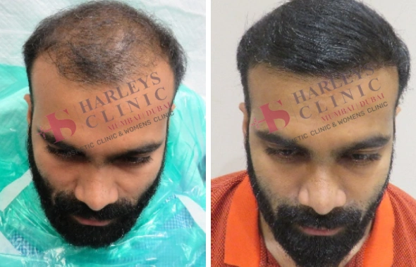 Natural Hair Growth by Hair Transplant Before and After 1