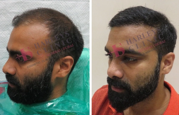 Natural Hair Growth by Hair Transplant Before and After 2